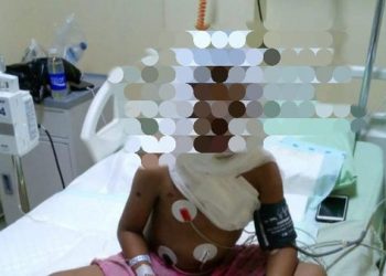 Bocah di Karangasem Mengalami Luka Parah Setelah Tersambar Api Saat Membakar Sampah