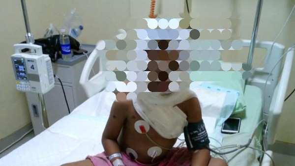 Bocah di Karangasem Mengalami Luka Parah Setelah Tersambar Api Saat Membakar Sampah